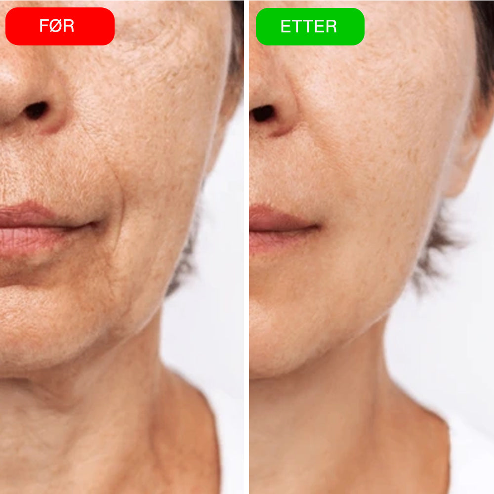 VIOCC™ OxyLuxe Dermal Infusjon