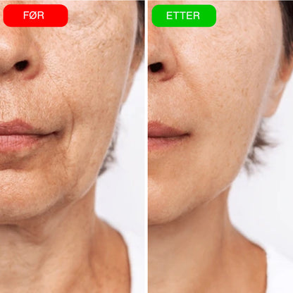 VIOCC™ OxyLuxe Dermal Infusjon