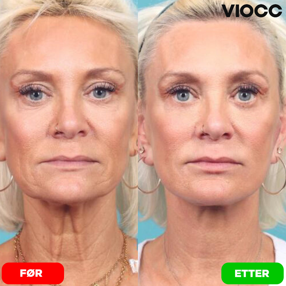 VIOCC™ Stram & Løft Nakekrem