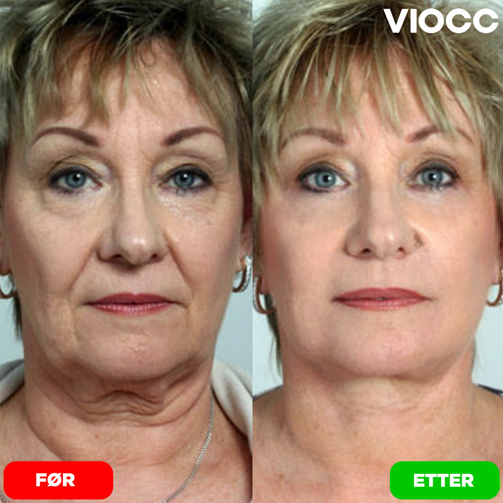 VIOCC™ Stram & Løft Nakekrem