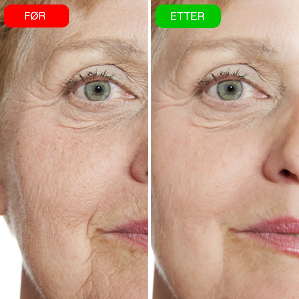 VIOCC™ OxyLuxe Dermal Infusjon