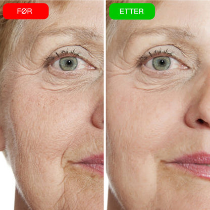 VIOCC™ OxyLuxe Dermal Infusjon
